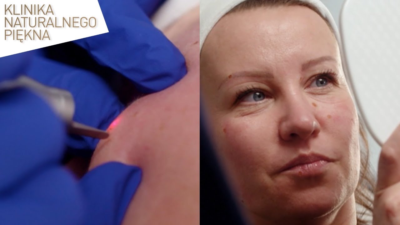 CZYM TAK NAPRAWDĘ SĄ PIEPRZYKI? Zobacz jak można je szybko laserowo usunąć!