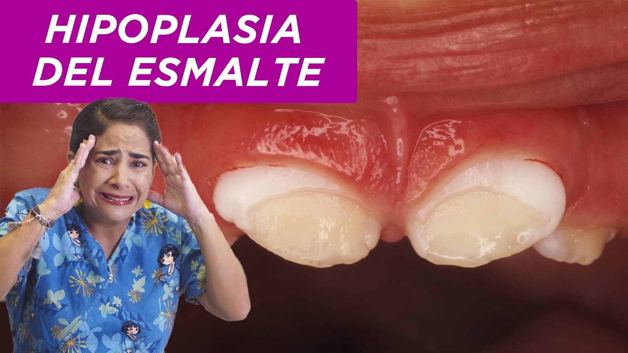 Hipoplasia del esmalte