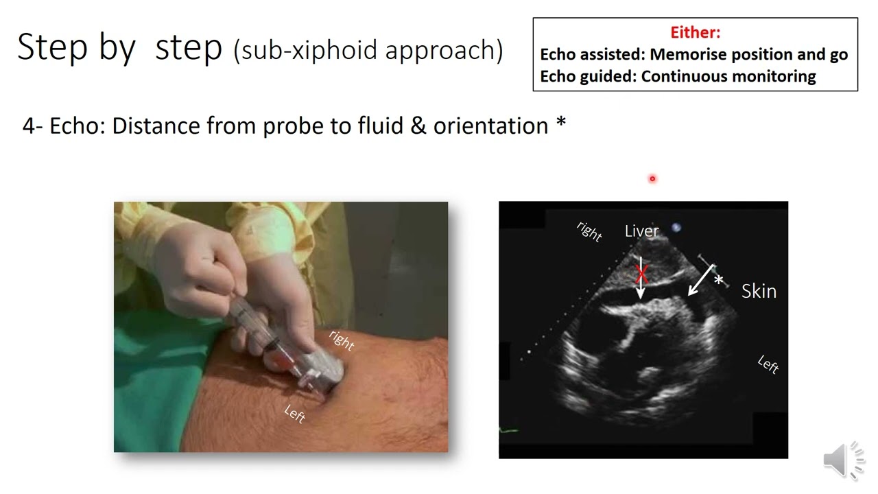 pericardiocentesis