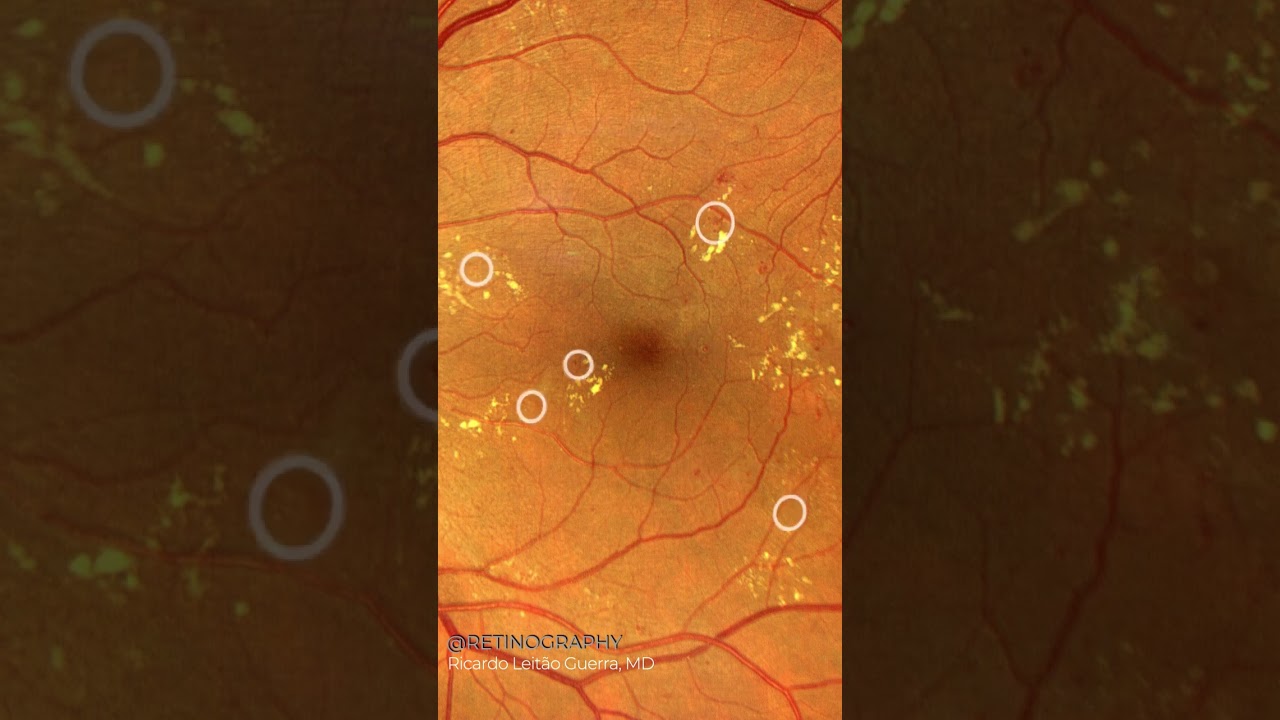 Diabetic retinopathy #retina #oftalmo #ophthalmology #oftalmologia #oftalmolog&iacute;a #ophtalmologie #о