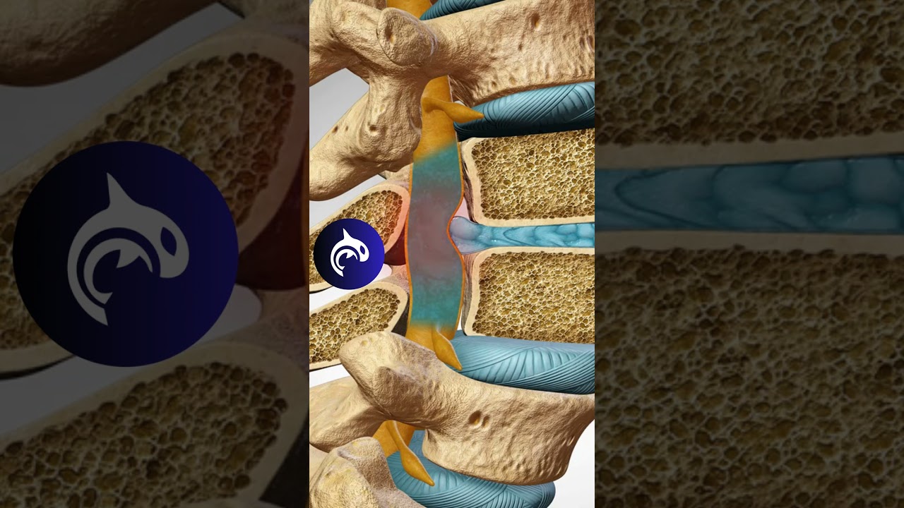 Lumbar Intervertebral Disc Herniation - 4K 3D Animation