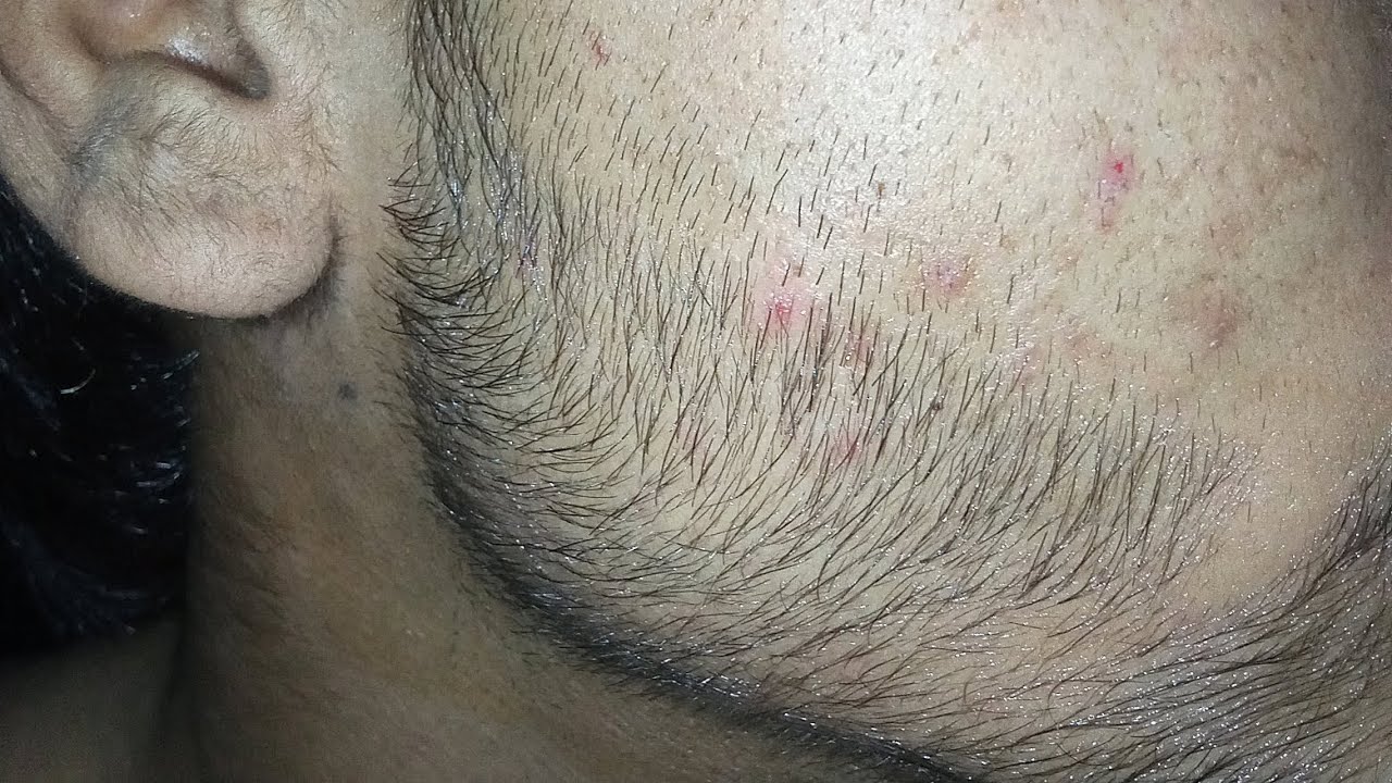 91 day (13 week) natural beard growth journey #manmatters #minoxidil #viralvideo 
