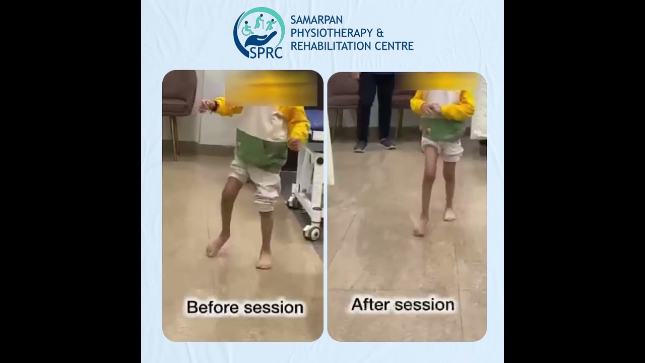 Case of spastic diplegic cerebral palsy