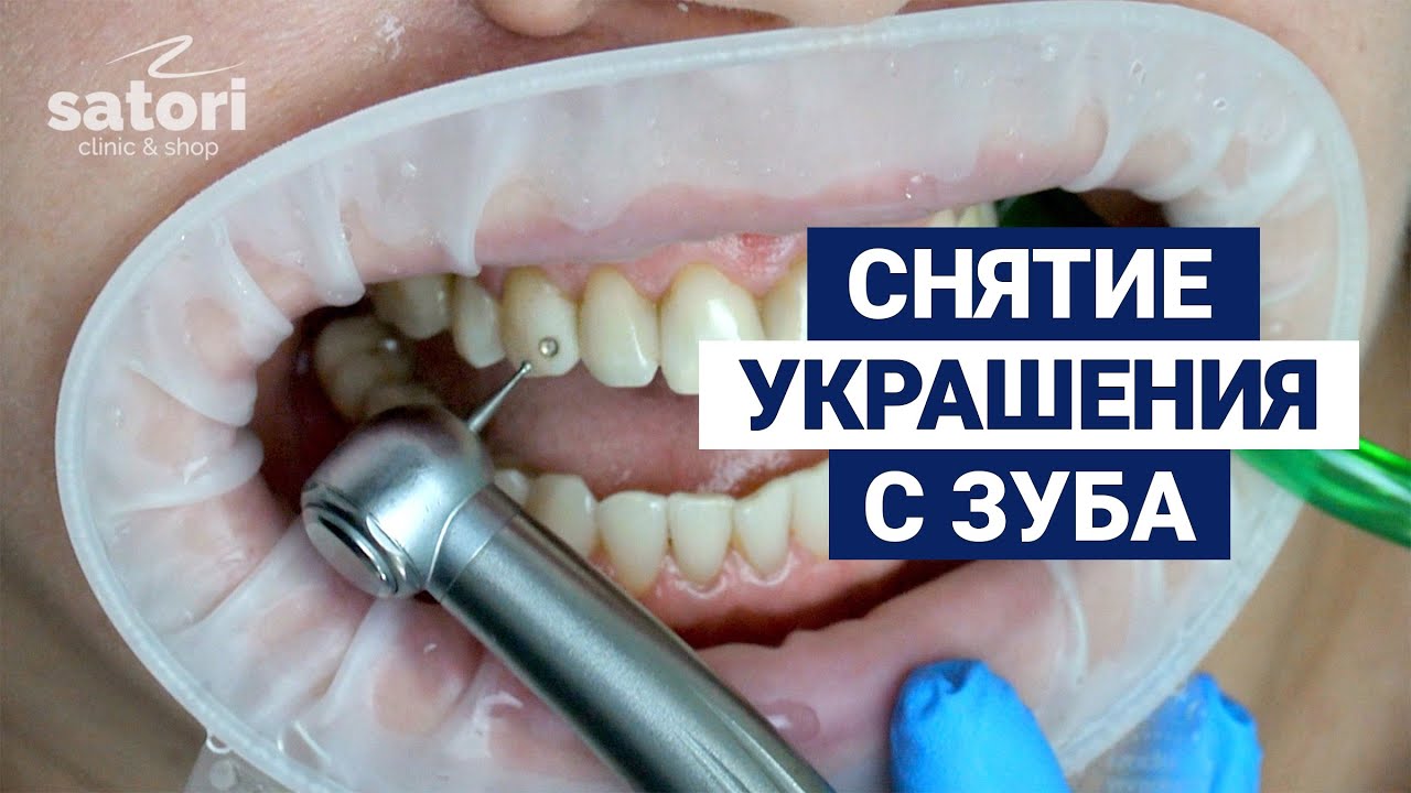 Usuwanie biżuterii skyce z zęba