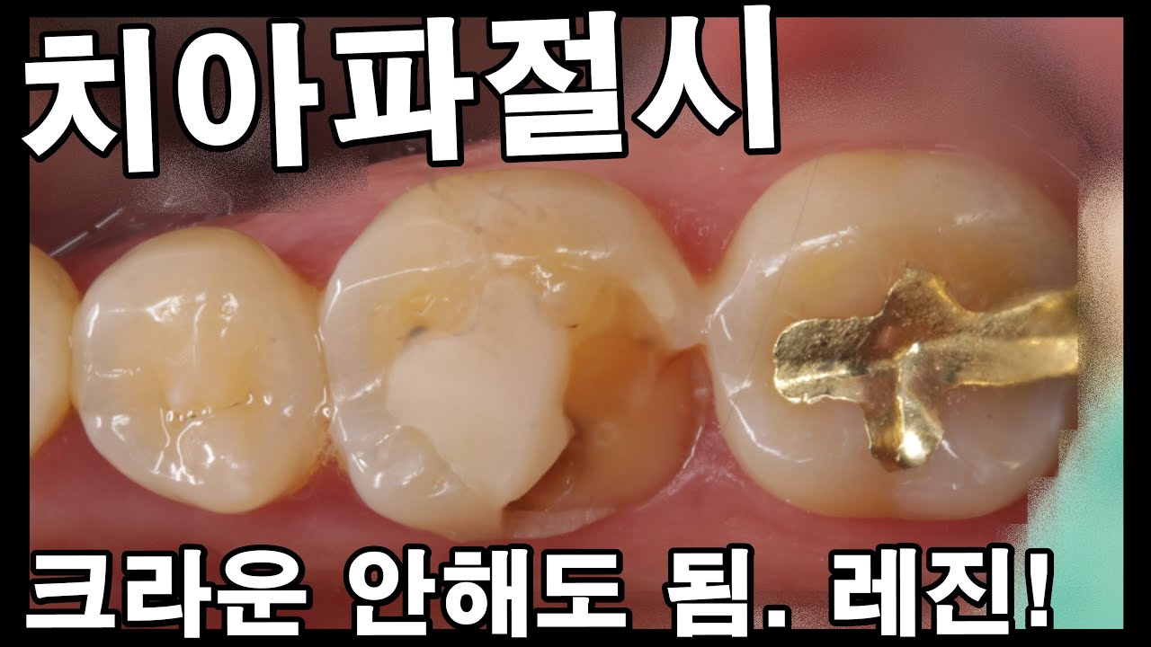 치아파절시 크라운 안해도 됨. 레진으로 충분. 자연치를 왜 깎아서 크라운을 함? 그랬다가 더 불편해질텐데... 어금니 깨짐 발생시 레진수복이 정담 #220202 2022_02_02