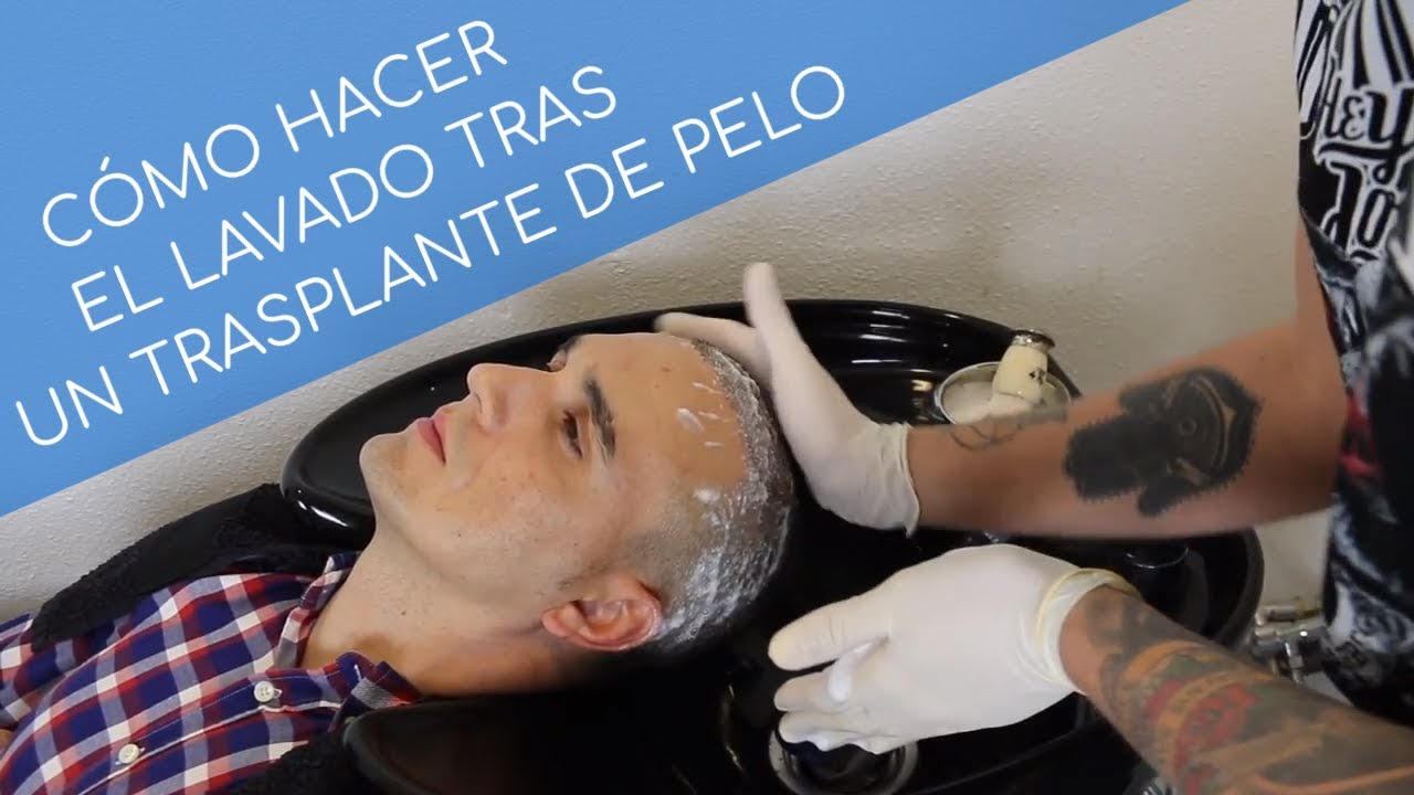 CÓMO HACER EL LAVADO TRAS UN TRASPLANTE DE PELO
