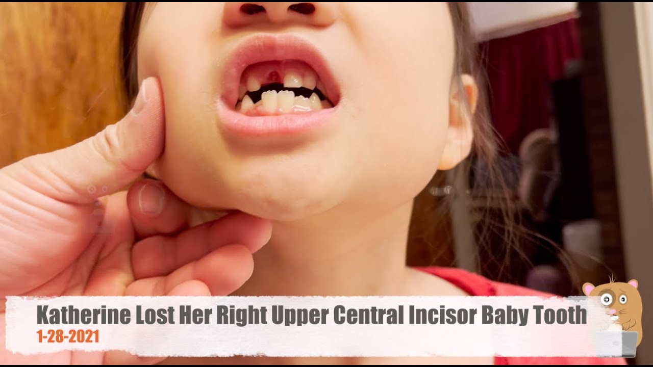 Katherine Lost Her Right Upper Central Incisor Baby Tooth
