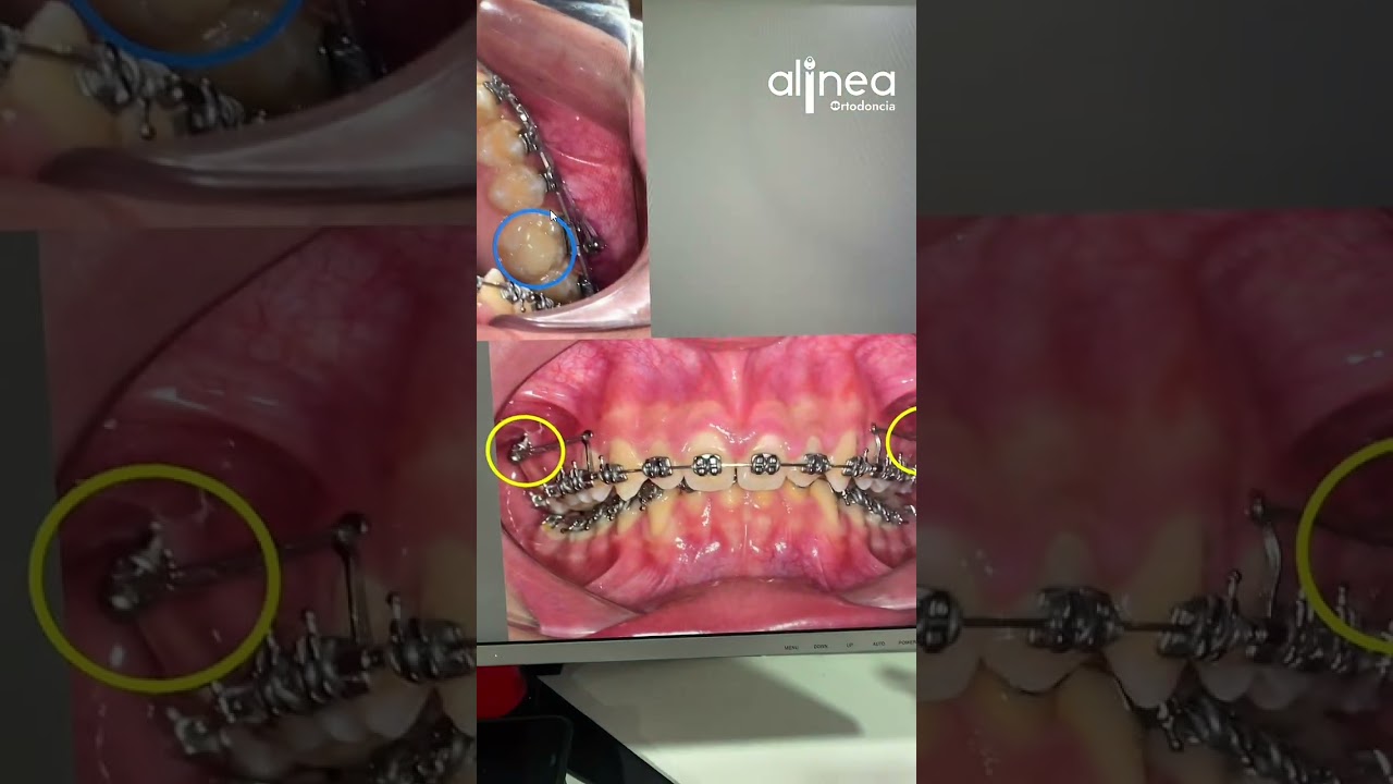 🦷 Maloclusi&oacute;n Clase II-1 con mordida profunda severa.