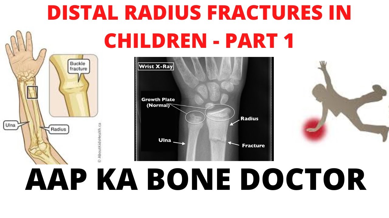 DISTAL RADIUS FRACTURES IN CHILDREN - PART 1 - EPISODE 44