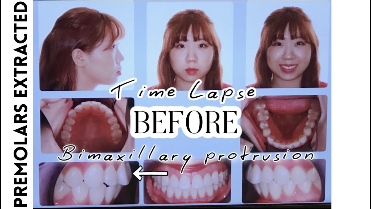 Braces Time Lapse (2 years 8 months)⎥4 Premolars Extracted, Bimaxillary Protrusion, Side Profile