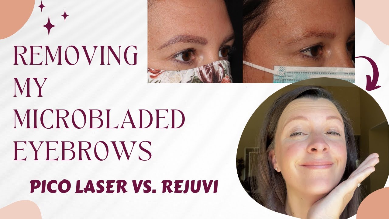 Microblading Removal- My Story |  PICO Laser vs. REJUVI with PHOTOS 2022