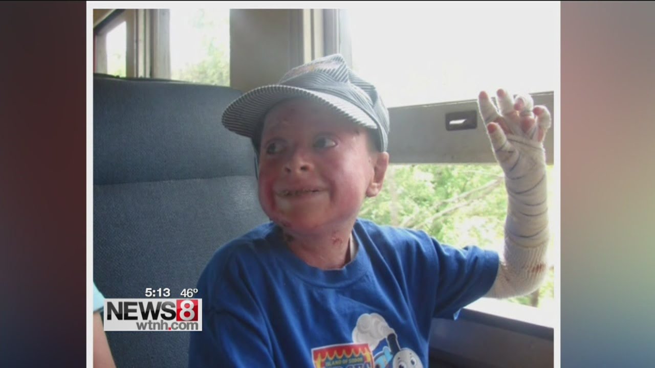 Dream comes true for teenager with rare skin disease