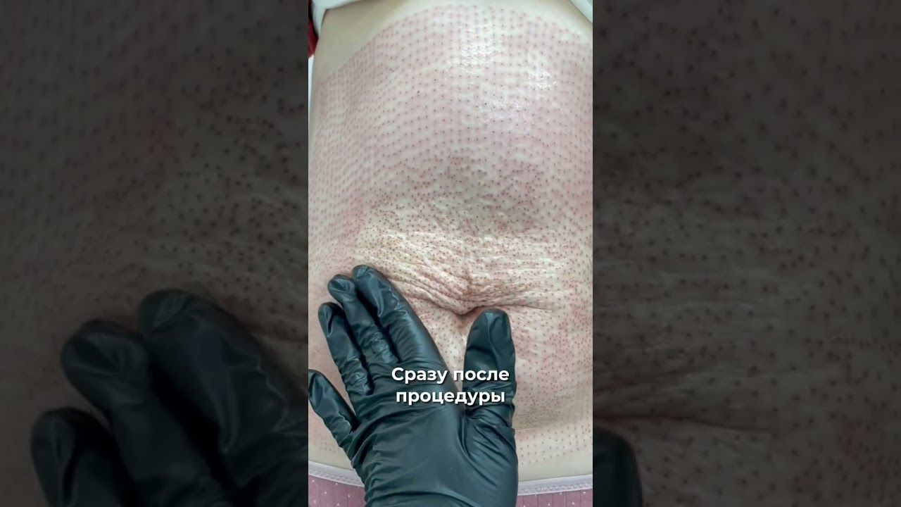 Как быстро убрать живот? В студии плазменной подтяжки кожи Skin Up💥