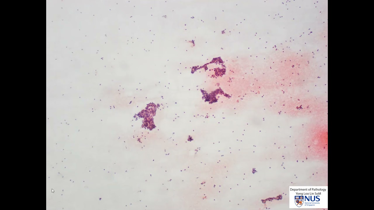 Thyroid cytology - Follicular neoplasm