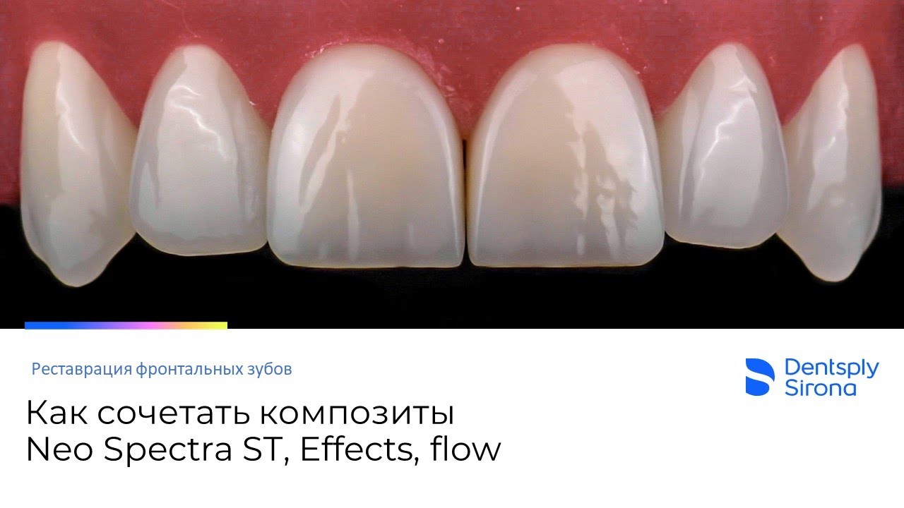 Как сочетать композиты Neo Spectra ST при реставрации по IV классу