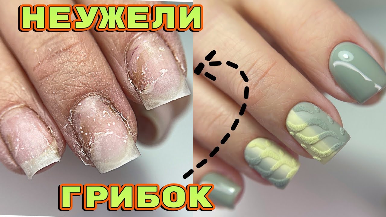 Пожелтели ногти 😐 Неужели грибок? Вязаный дизайн ногтей 💅Маникюр