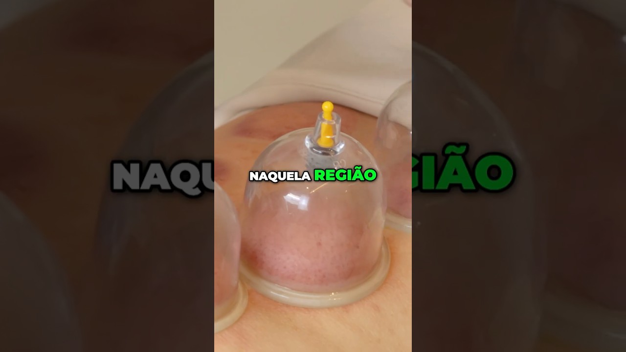 Como VENTOSATERAPIA funciona? Como as VENTOSAS promovem RELAXAMENTO? #quiropraxia #ventosaterapia