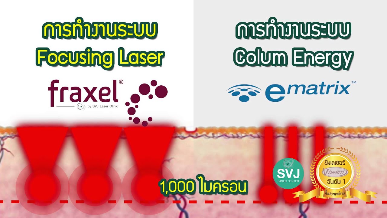 รักษาหลุมสิว fraxel หรือ ematrix เครื่องไหนดีกว่ากัน