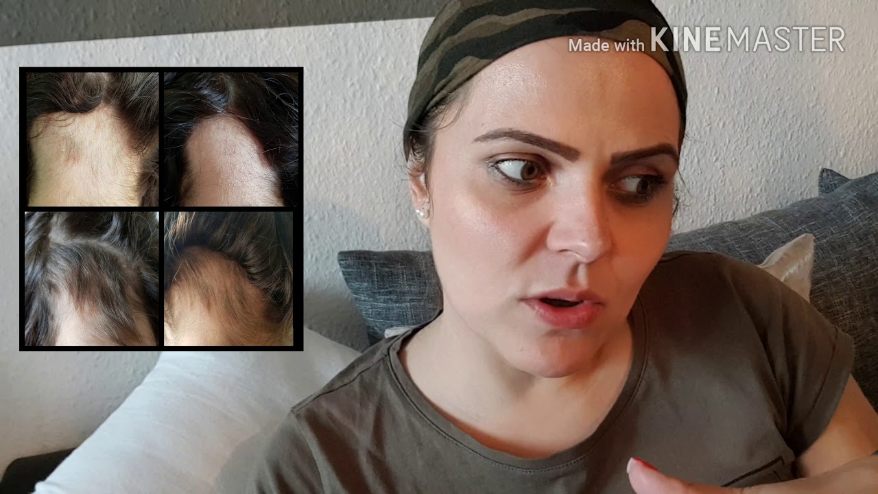 Kreisrunder Haarausfall VLOG 2 - Wie alles begann + Update 4 Monate 3 Wochen Alopecia
