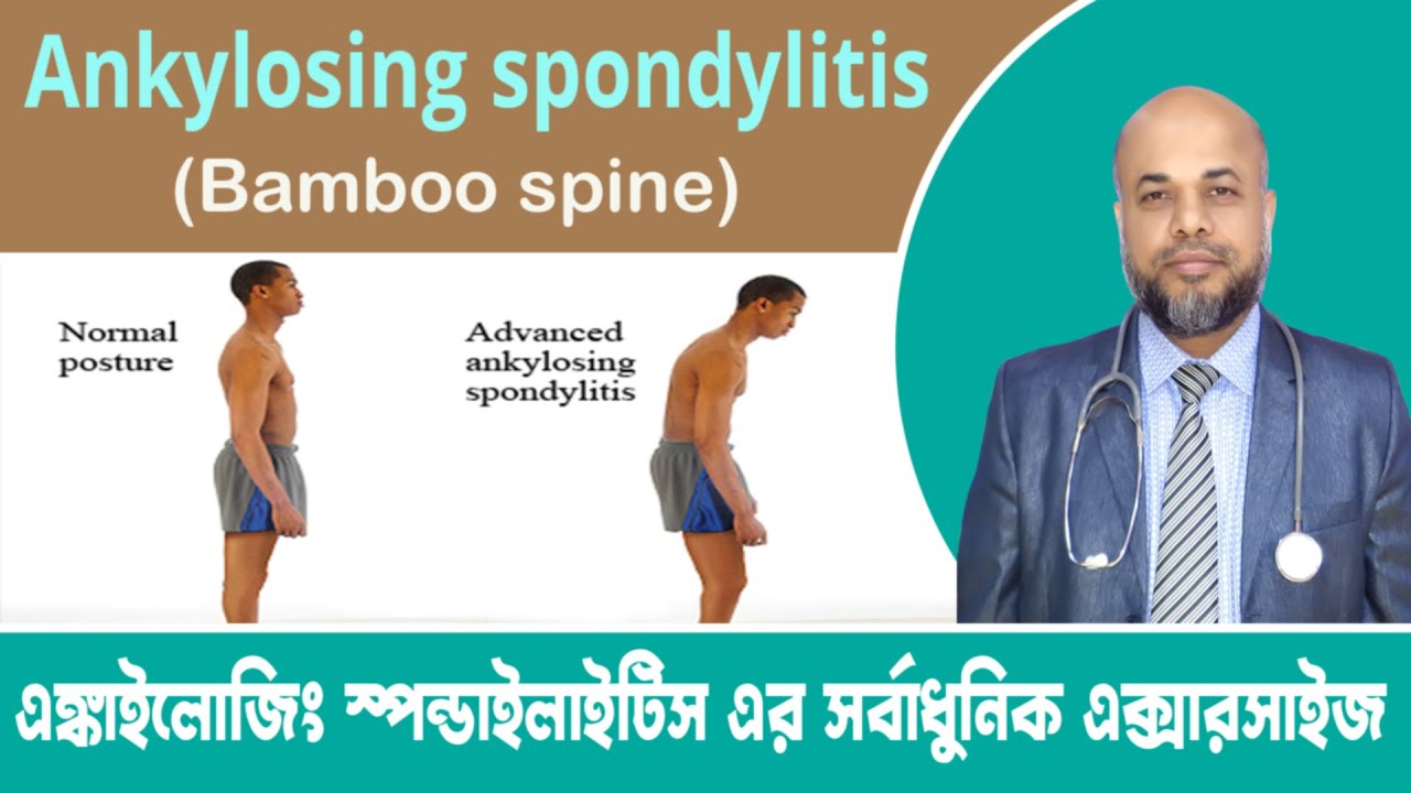 Ankylosing spondylitis (Bamboo spine) এঙ্কাইলোজিং স্পন্ডাইলাইটিস এর সর্বাধুনিক এক্সারসাইজ | AS
