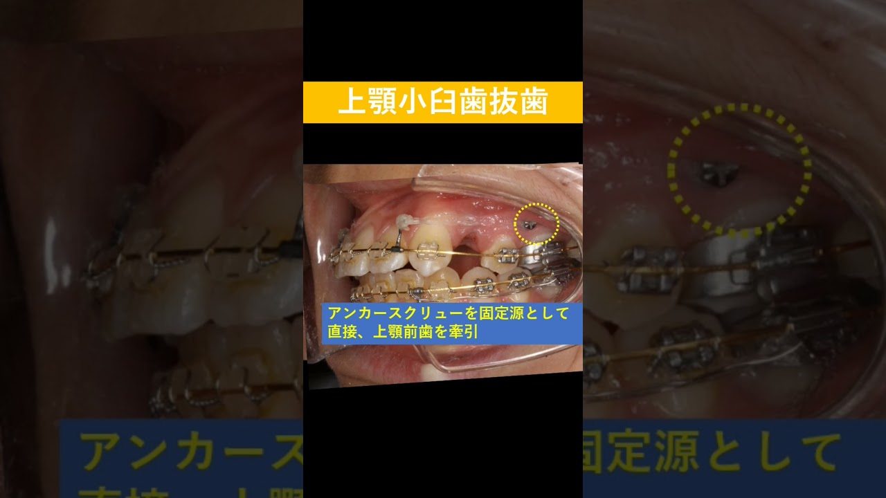 出っ歯│歯科矯正用アンカースクリュー│上顎前突│歯列矯正│#shorts