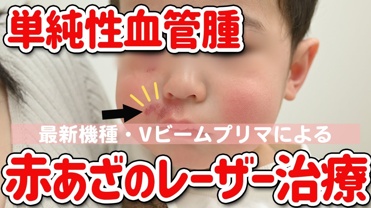 【単純性血管腫】最新のVビームプリマを使用したレーザー治療！気になるカウンセリング～実際の治療風景まで、全てお見せします【こどものあざ・赤あざ】