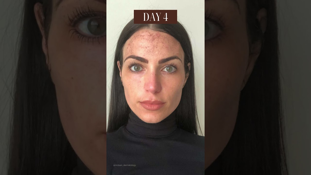 What to expect from your IPL treatment! #ipl #cosmeticlaser #lasertreatment