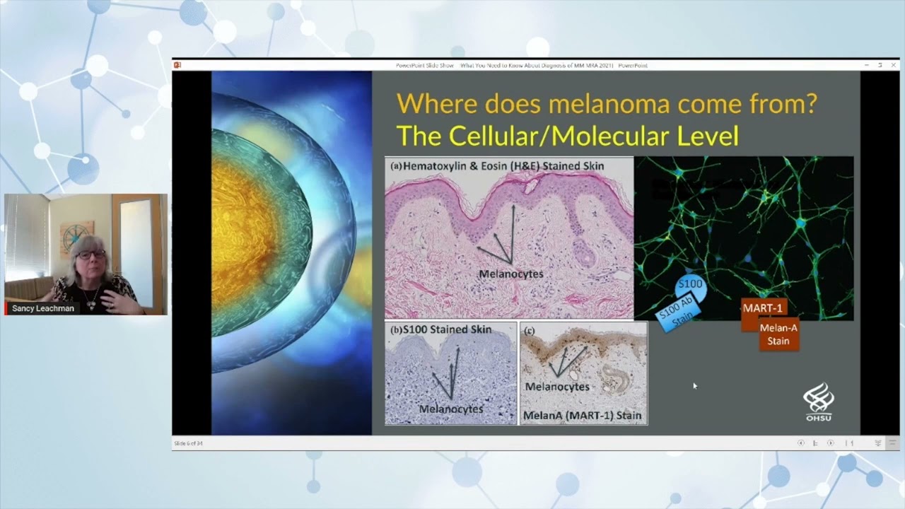 What You Need to Know: Diagnosing Melanoma