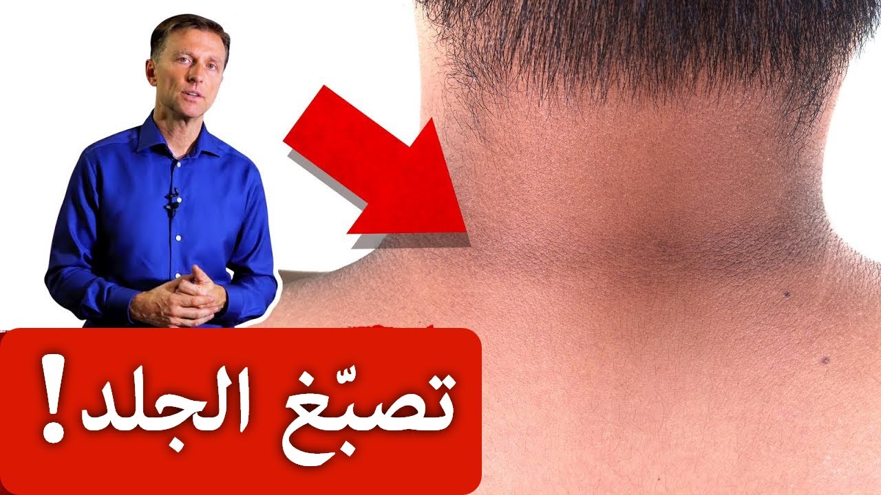 الحل لتصبغات الجلد في الرقبة وتحت الابط وأماكن أخرى!