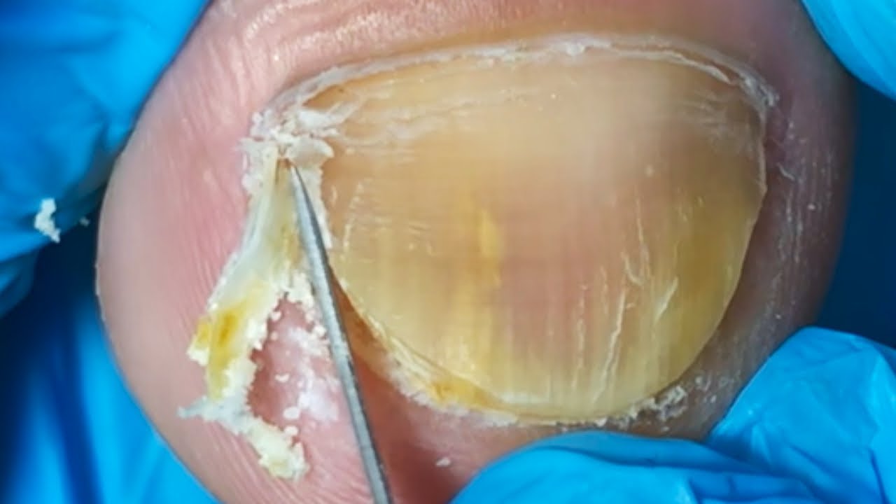 My Toenails Are Yellow And Dry; I Trimmed The Damaged Nails On Both Sides