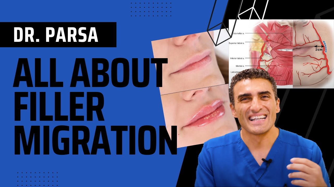 All About Filler Migration with Dr. Parsa