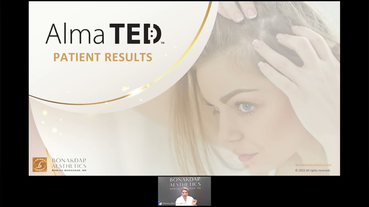 Alma Ted Hair Restoration Webinar