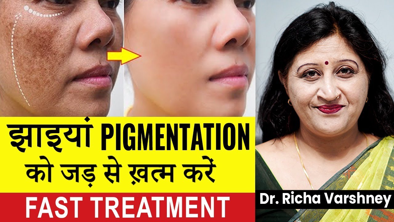 Skin Pigmentation Treatment Home Remedies | How to Cure Melasma Naturally | Jhaiya hatane ke tips