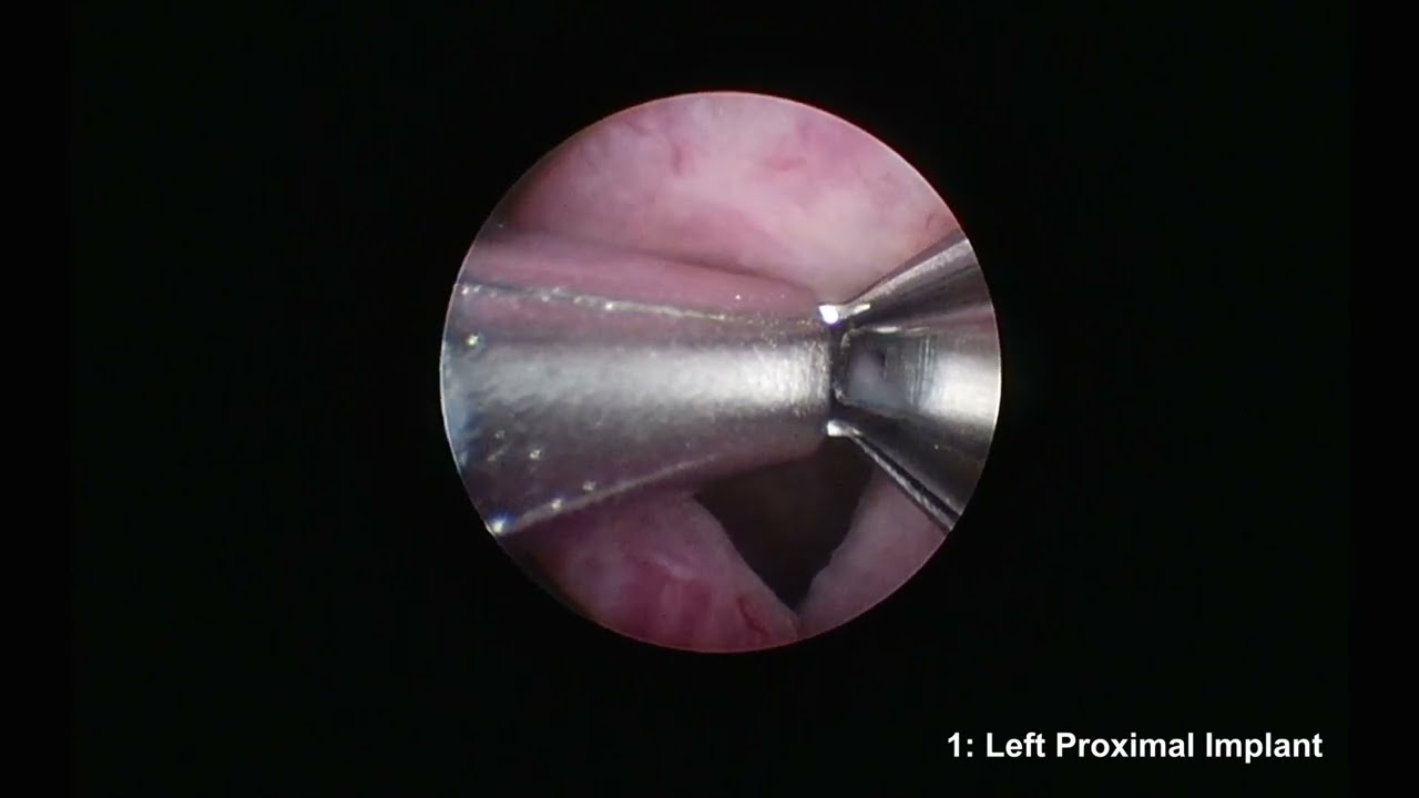 How I Do It: The prostatic urethral lift for obstructive median lobes