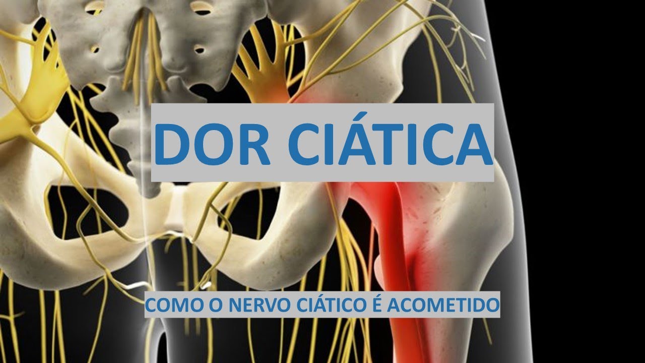 DOR CIÁTICA     Como o Nervo Ciático é Acometido