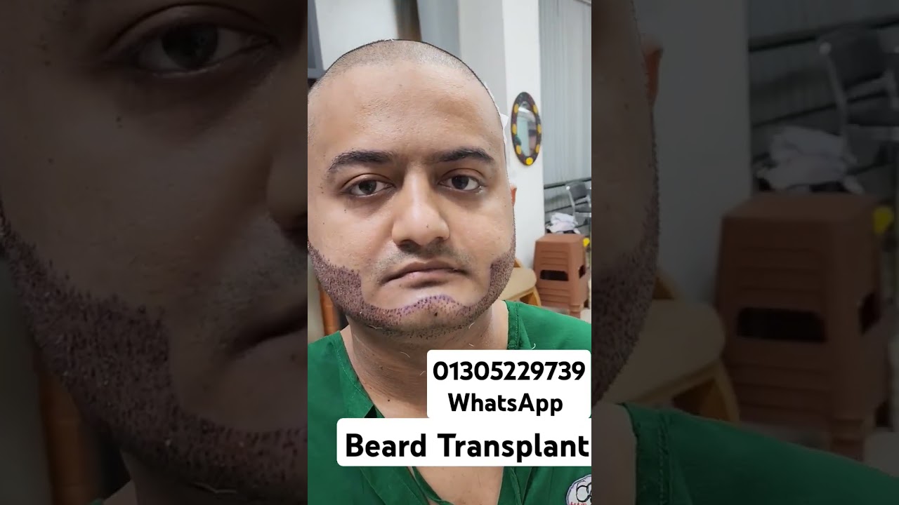 Beard Transplant Bangladesh | Beard Transplant 2000 Grafts 