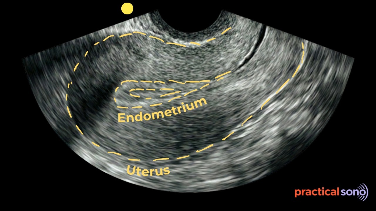 Measurement of Endometrial Thickness (Standard Protocol)