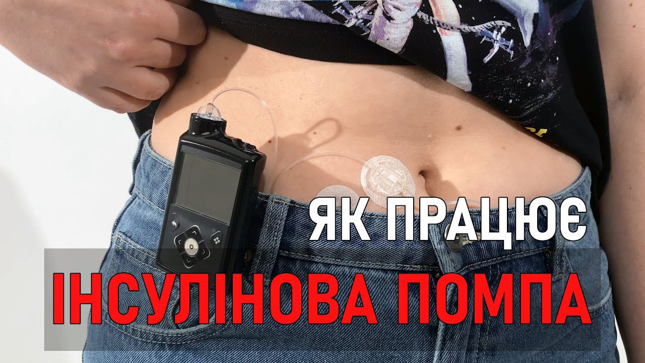 Як працює інсулінова помпа