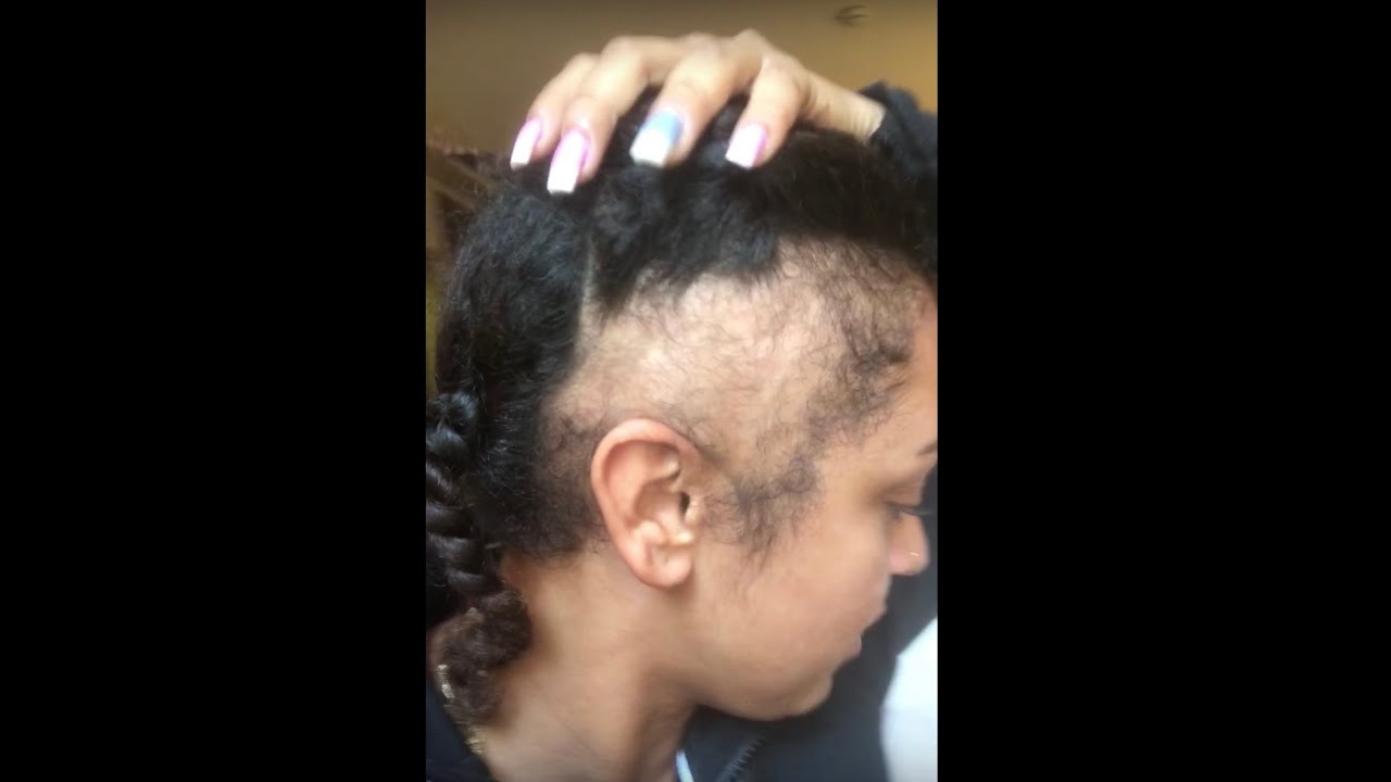 Hair Vlog #1 | The Day Of My Hair Transplant | LONGEVITA CLINIC