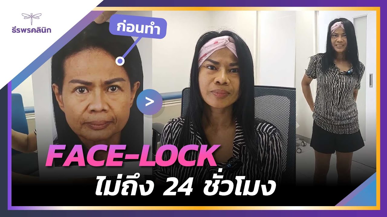 สดๆออกจากห้องผ่าตัด ดึงหน้า Face-Lock ธีรพรคลินิก หมอชลธิศ