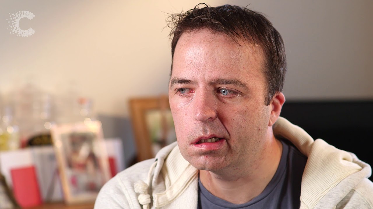 Salivary Gland Cancer: Dad who lost his smile to cancer following treatment | Cancer Research UK