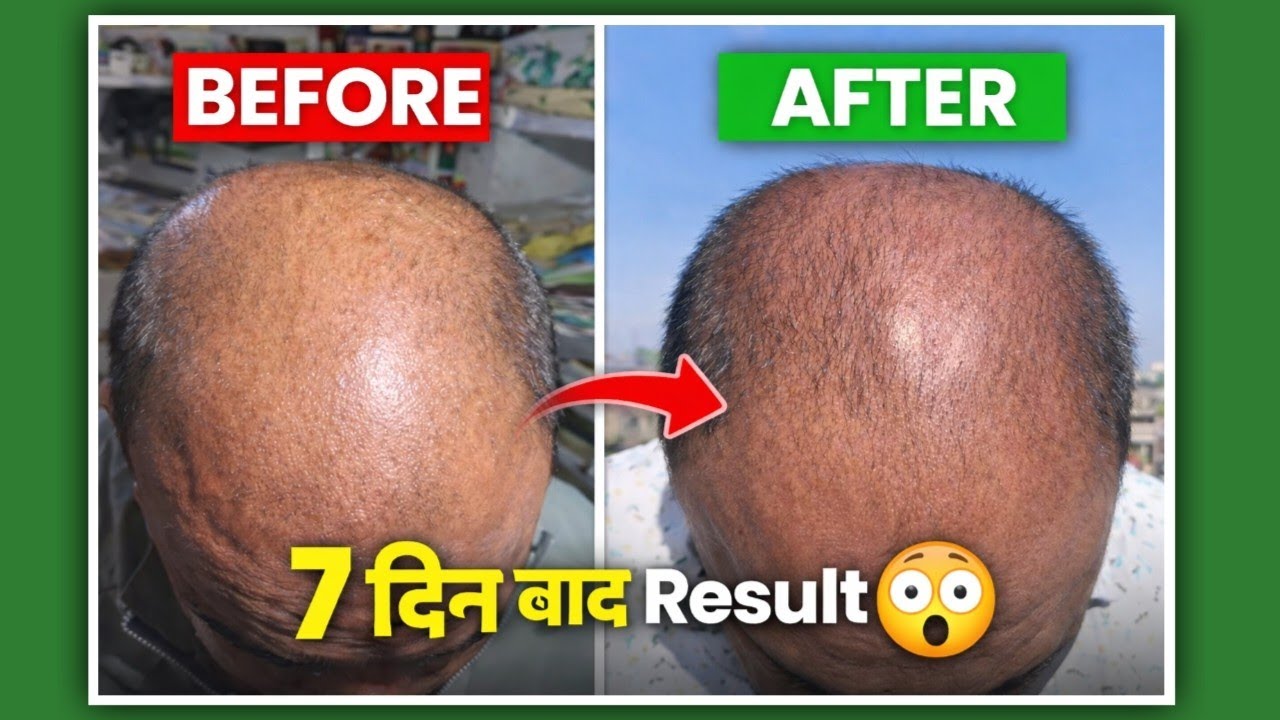 Moregro F 5 Solution 7 Days Result 😲 | Minoxidil + Finasteride Hair Growth Reality