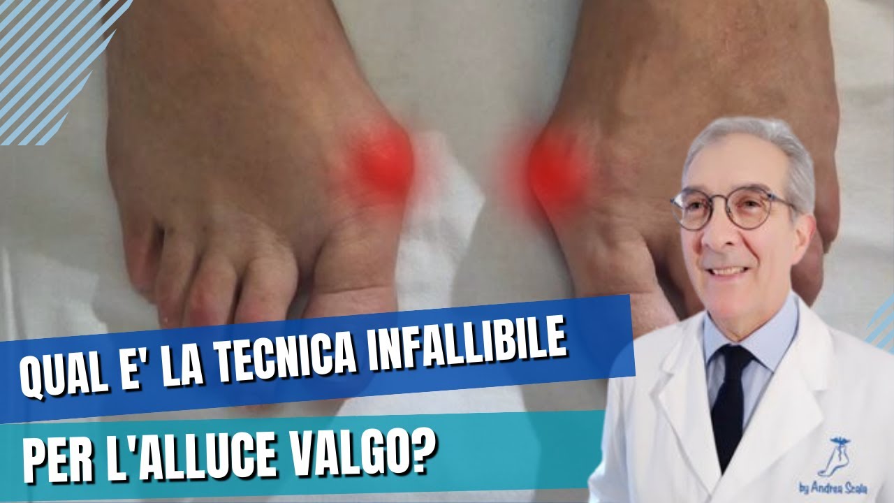 Alluce valgo bilaterale: sintomi, diagnosi e intervento | Dott. Andrea Scala specialista del piede
