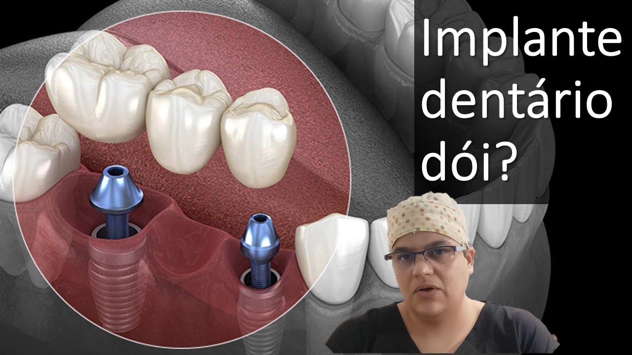 Implante dentário dói? | Dra Bianca Rosa | Clínica Bianca Rosa