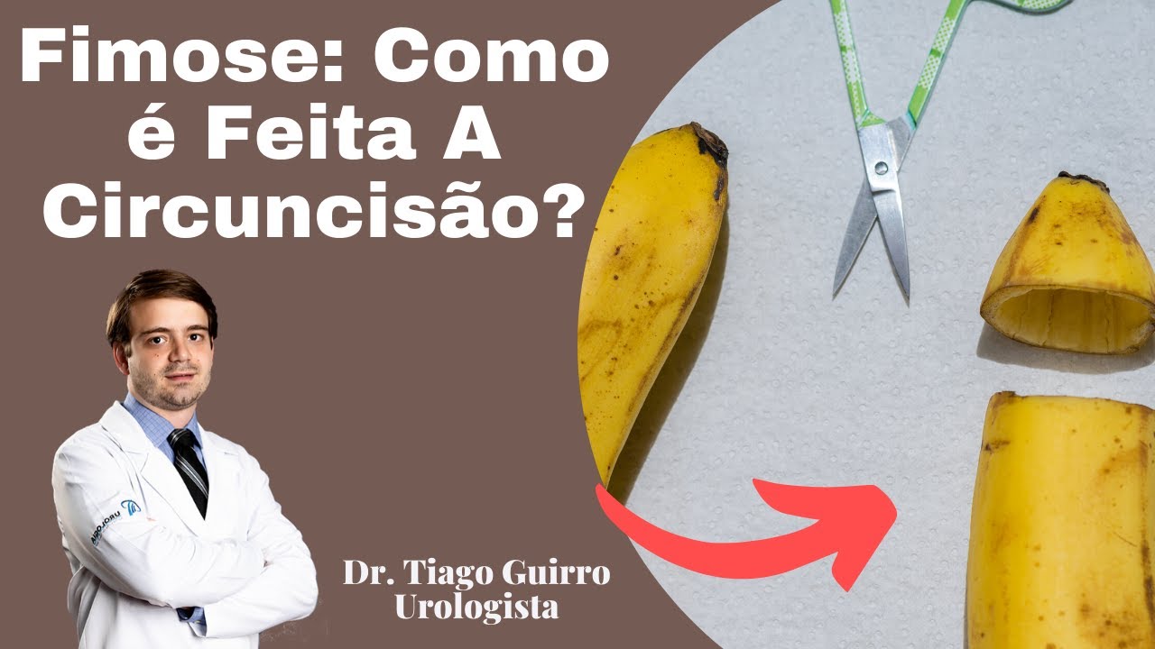Fimose: Como &eacute; Feita A Circuncis&atilde;o?
