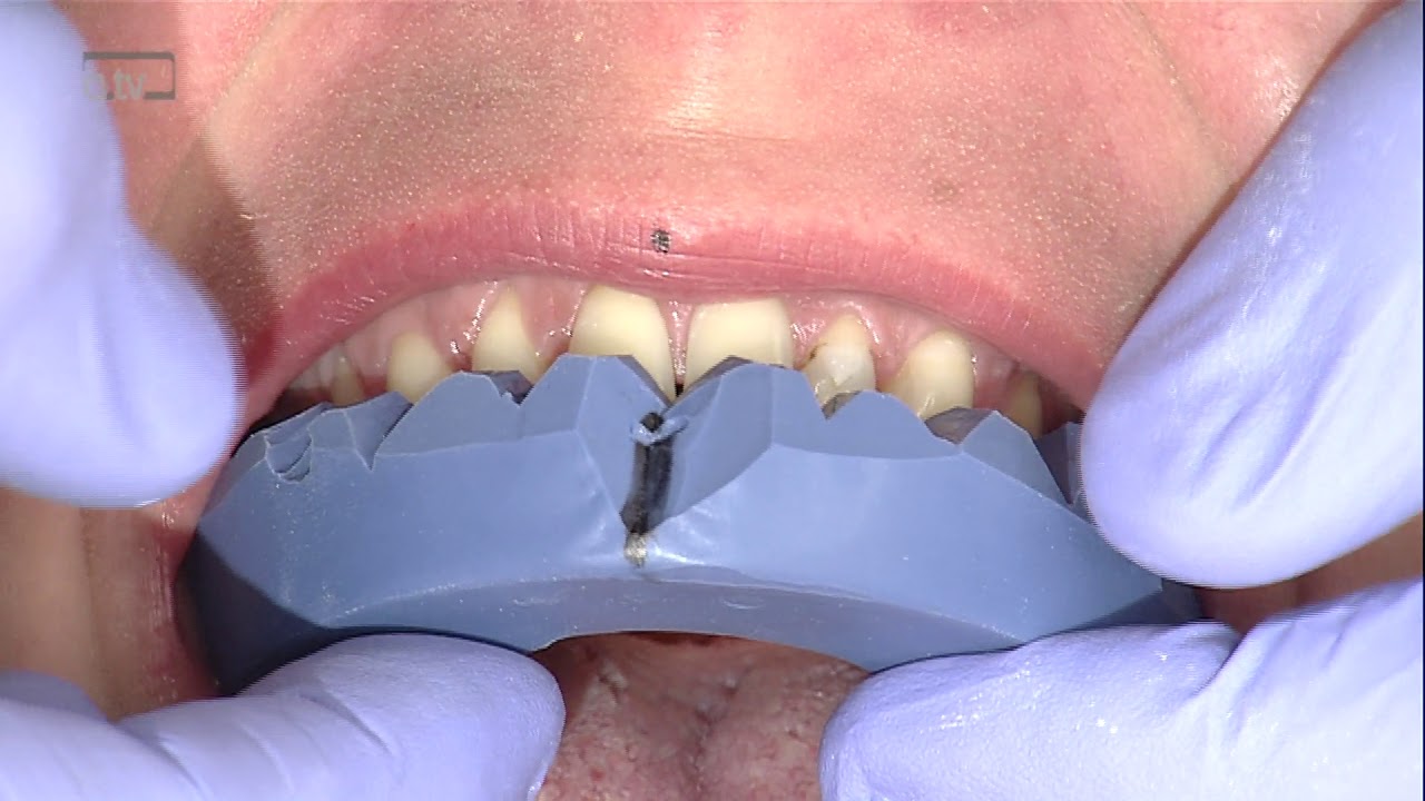 Ästhetische Frontzahnversorgung mit Veneers