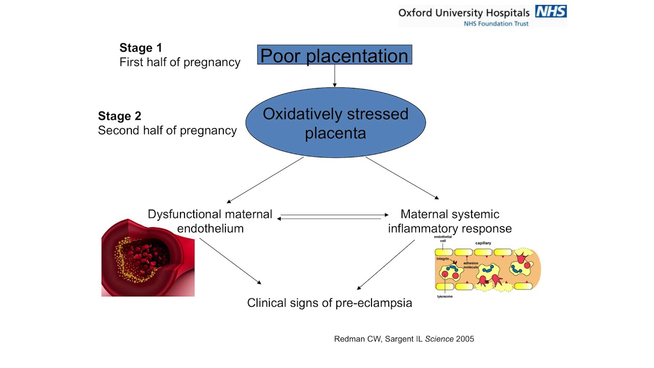 Diagnosis and managing of pregnancy related TMA (HELLP/PET) - Dr Lucy MacKillop