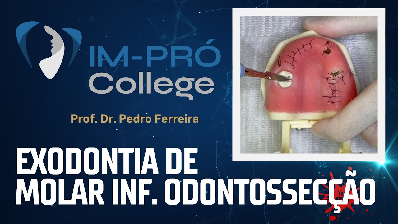 Exodontia de Molar Inferior com Odontossec&ccedil;&atilde;o - Dente 37 Manequim