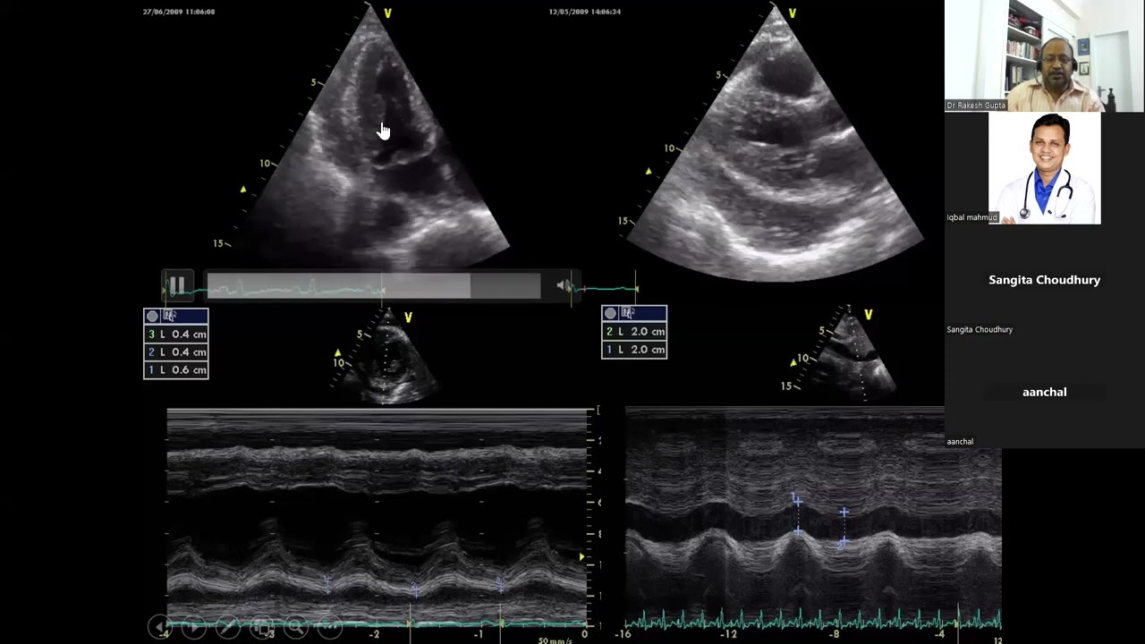 2023 03 12 20 10 35 Constrictive vs Restrictive pericarditis by Dr Rakesh Gupta