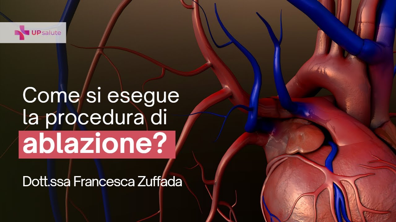 Come si esegue la procedura di ablazione? - Dott.ssa Francesca Zuffada - UPsalute Channel